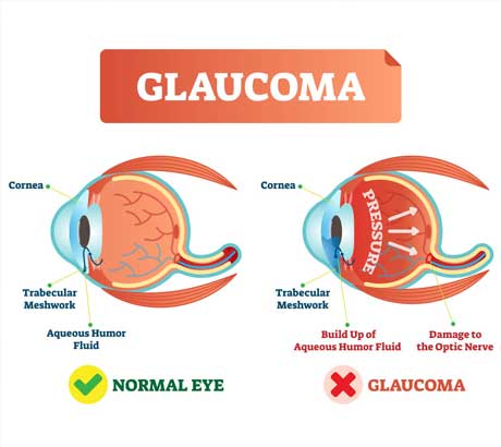 Glaucoma-Diagnosis